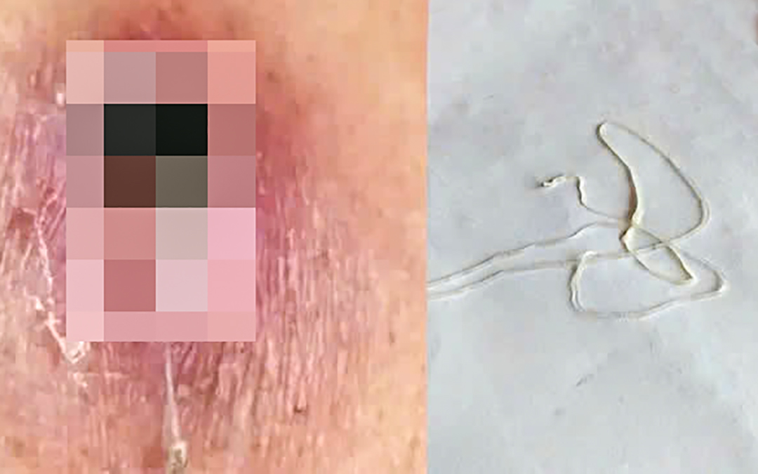 Tổng quan về bệnh giun rồng