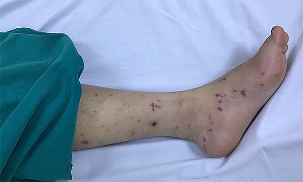 Nguyên nhân gia tăng ca bệnh